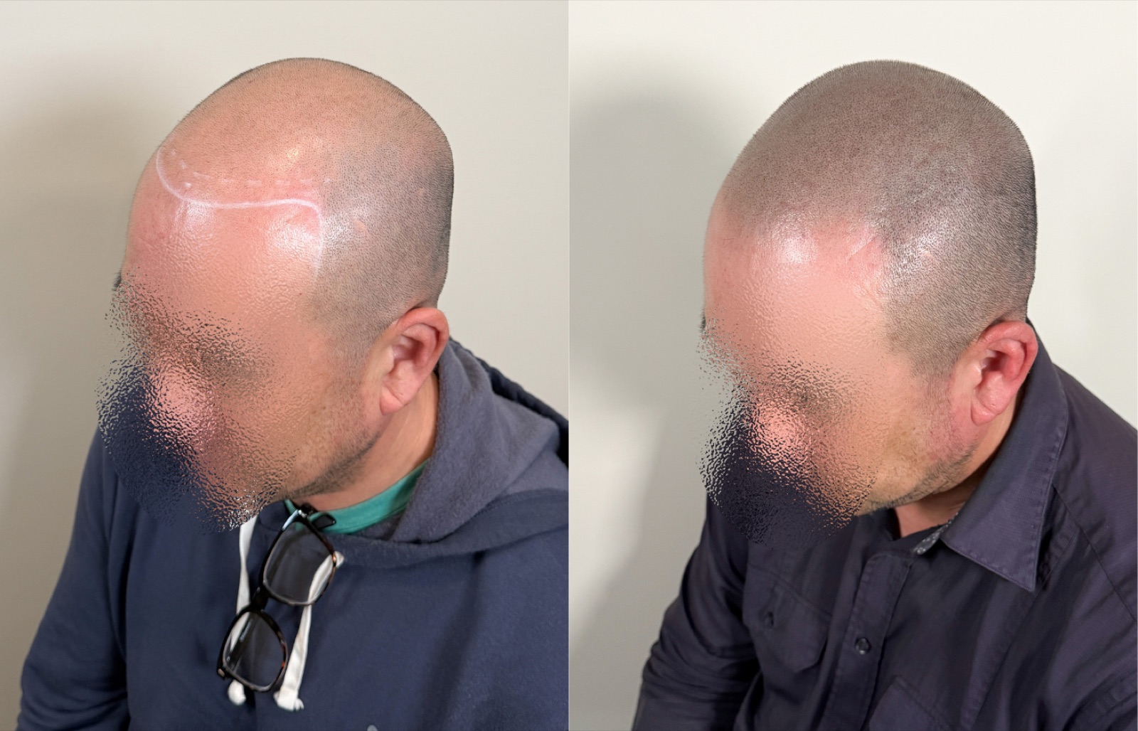 Shaved look SMP portfolio 3